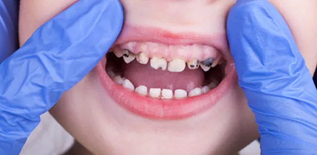 Diş Çürüklerinin Nedenleri Nelerdir?