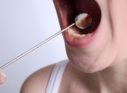 Ağız Kanseri Nedir? Ağız Kanseri Belirtileri