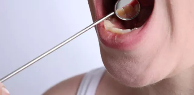 Ağız Kanseri Nedir? Ağız Kanseri Belirtileri