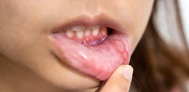 Ağız Yarasına Ne İyi Gelir?