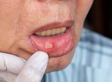 Damakta Aft Nasıl Geçer?