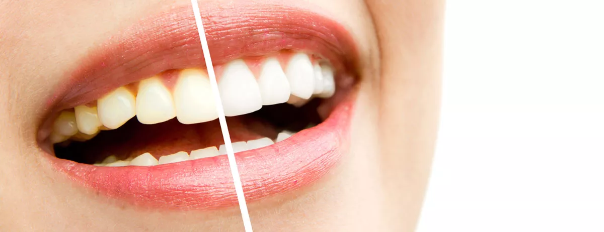 Diş Beyazlatma Dişe Zarar Verir Mi?