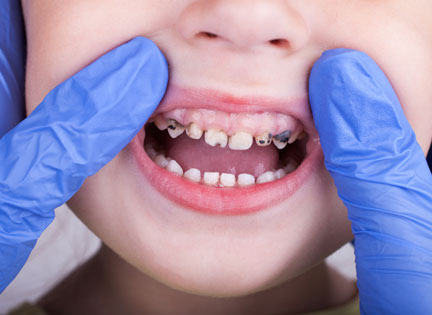 Diş Çürüklerinin Nedenleri Nelerdir?