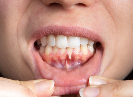 Diş Eti Çekilmesi (Periodontitis) Nedir?