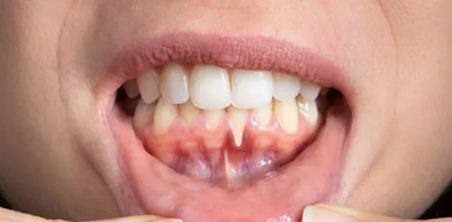 Diş Eti Çekilmesi (Periodontitis) Nedir?