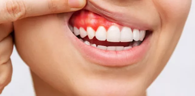 Diş Eti Estetiği (Gummy Smile Botoks) Nedir? Nasıl Yapılır?