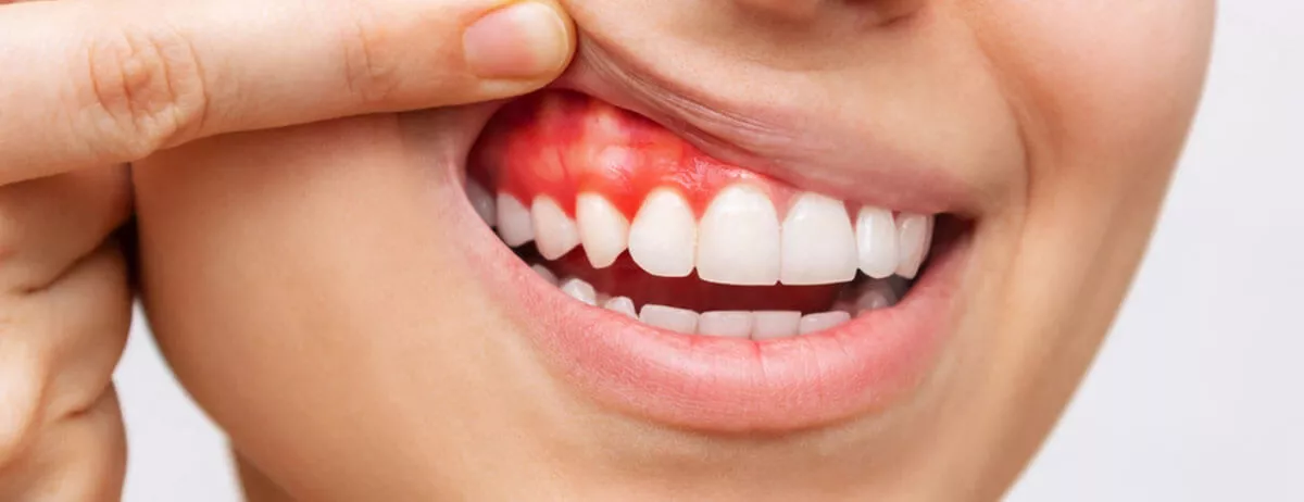 Diş Eti Estetiği (Gummy Smile Botoks) Nedir? Nasıl Yapılır?