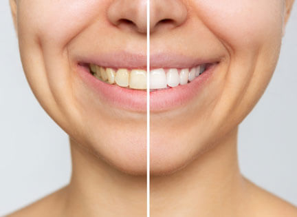 Diş Minesi Nasıl Güçlendirilir?