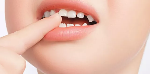 Diş Sallanması Nedir?