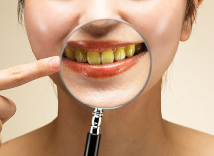Diş Sararması Neden Olur? Nasıl Geçer?