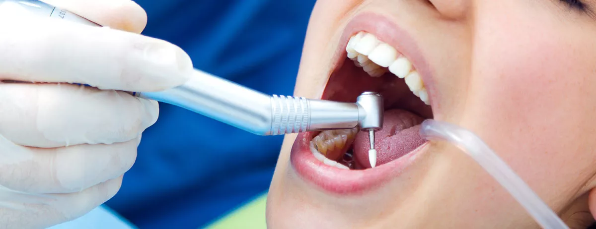 Diş Taşı Temizliği Dişe Zarar Verir Mi?