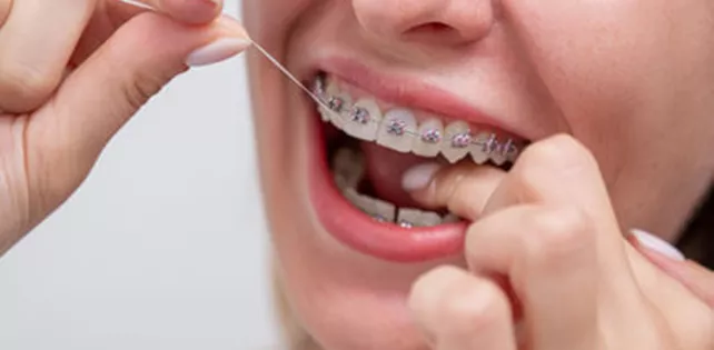 Diş Teli Tedavisi Nedir?