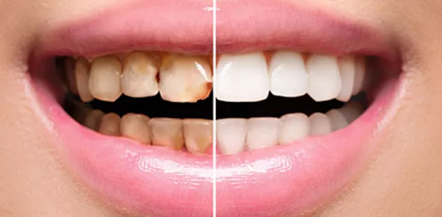 Restoratif Diş Tedavisi Nedir?