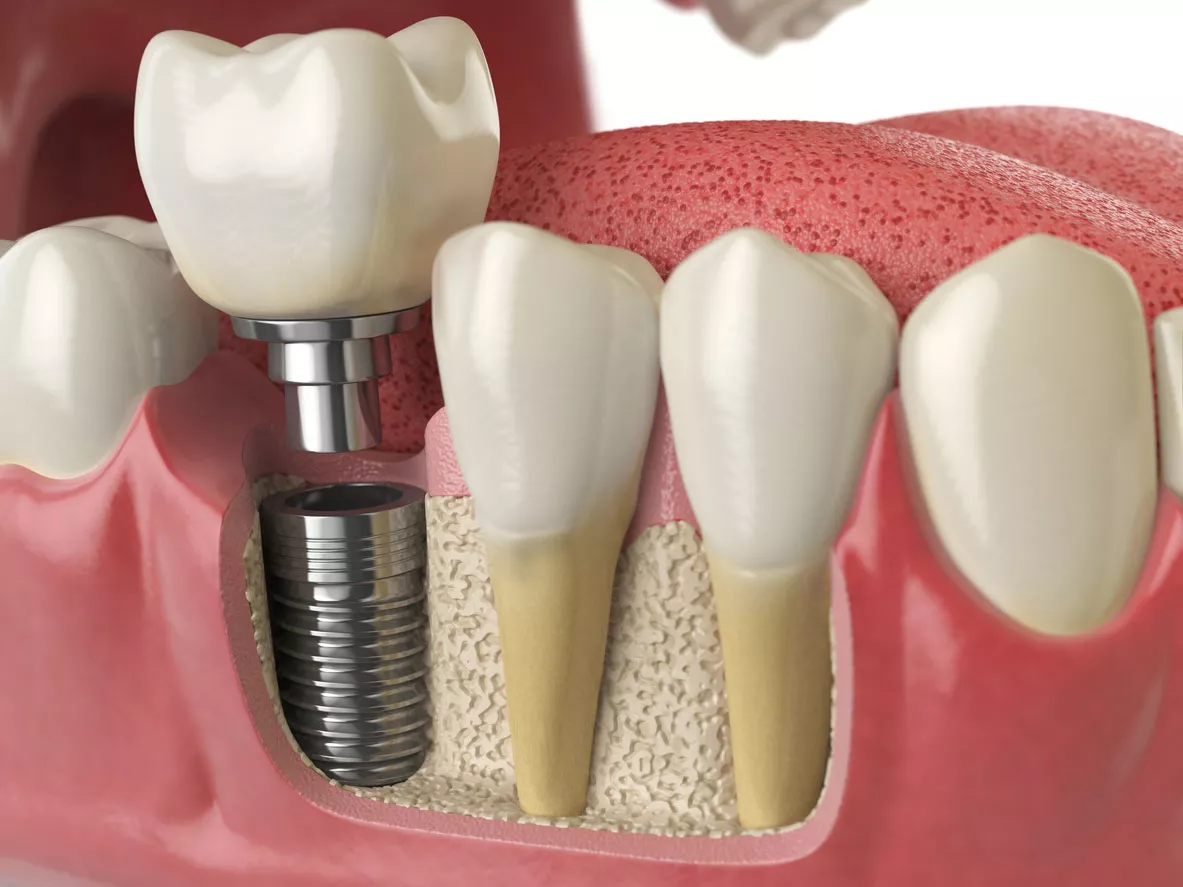 Tek Diş Implantı
